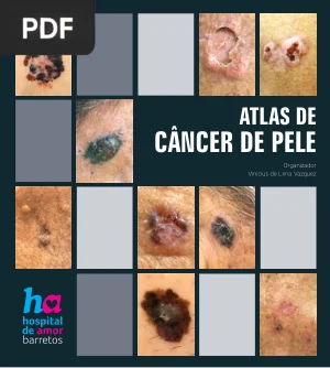 Atlas de Câncer de Pele